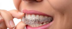 photo-service-mouthguards photo-service-mouthguards